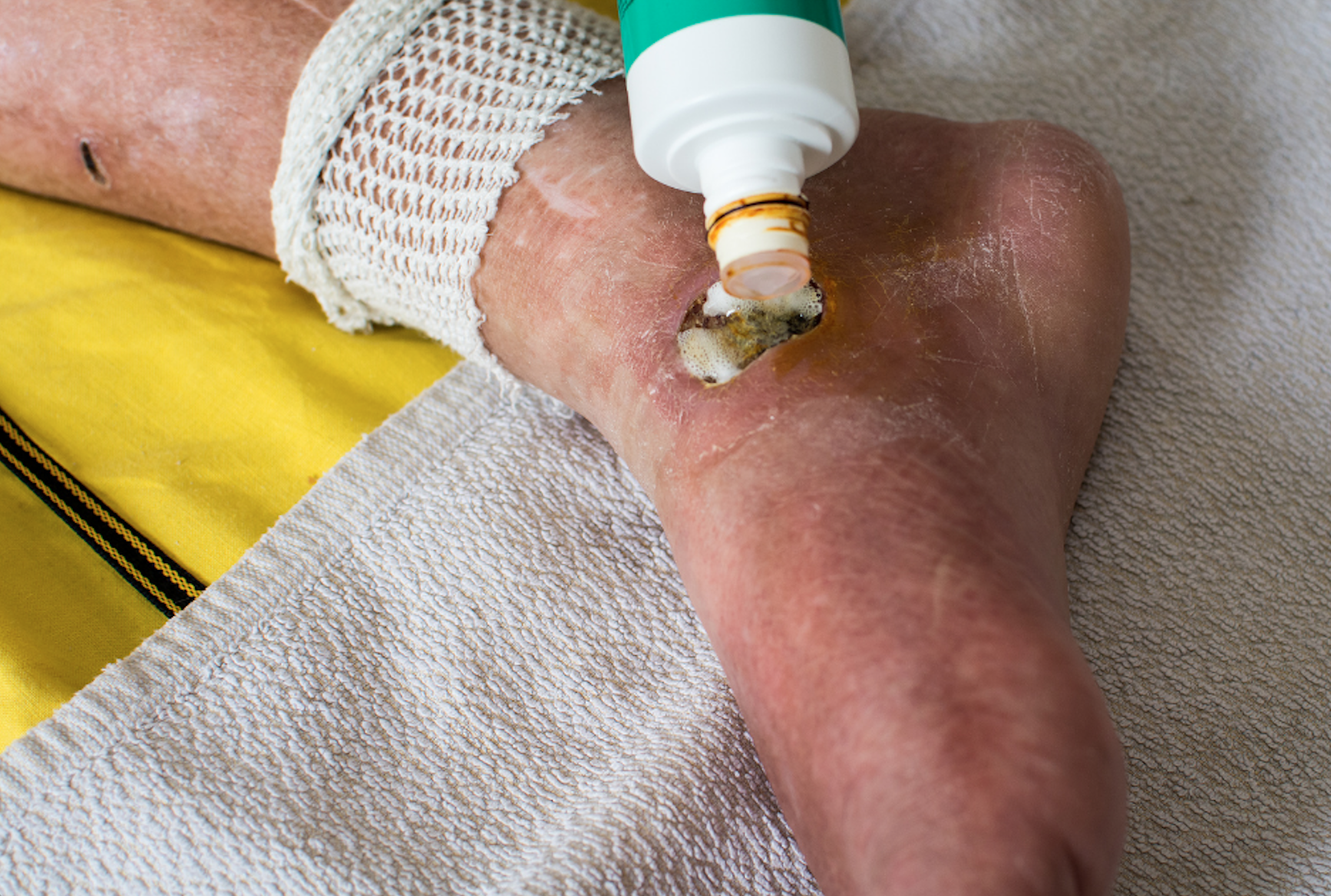 פצעים סכרתיים